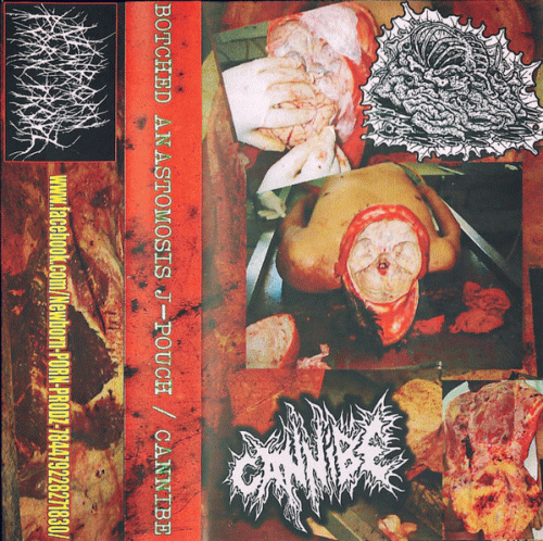 Cannibe : Cannibe - Botched Anastomosis J-Pouch